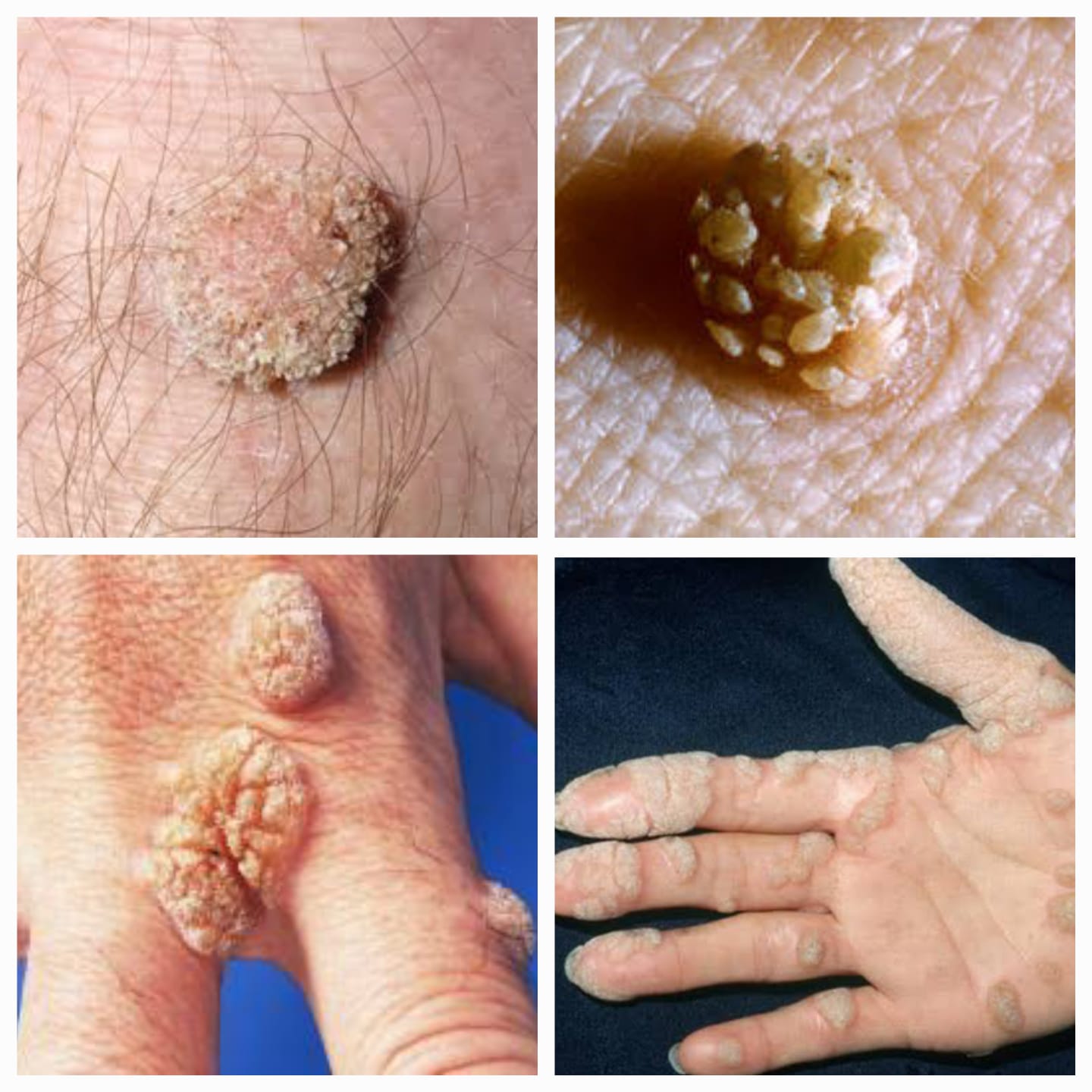 WARTS - चामखीळ